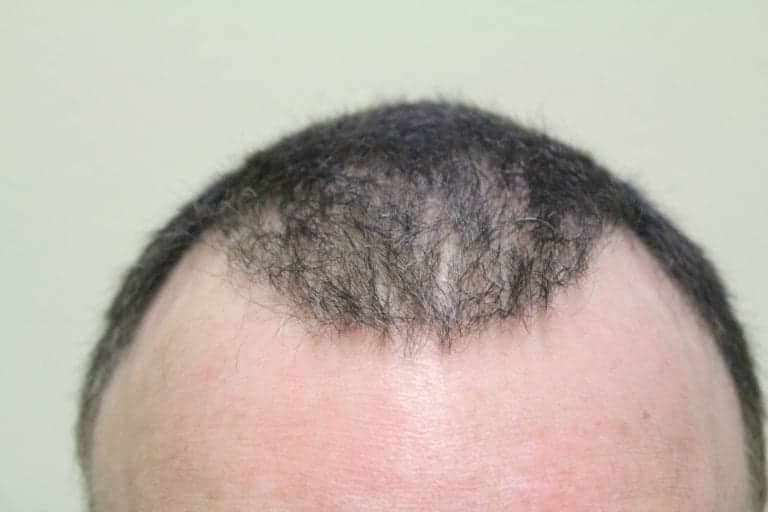 Previous bad hair surgery outcome
