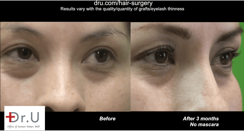 Dr.UGraft™’s unique design now makes it possible to use FUE grafts for eyelash transplants.* Dr.UGraft™’s unique design now makes it possible to use FUE grafts for eyelash transplants.*