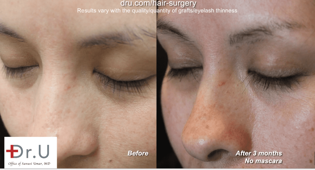 Three months after her Dr.UGraft eyelash implant surgery in Los Angeles, the patient had thicker longer eyelashes even without mascara.* Three months after her Dr.UGraft eyelash extension surgery in Los Angeles, the patient shows excellent growth of her nape hair grafts
