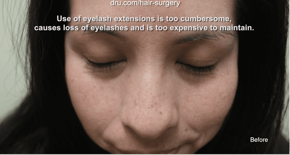 This patient had thin and sparse eyelashes before Dr.UGraft’s eyelash extension surgery. This patient had thin and sparse eyelashes before Dr.UGraft’s eyelash extension surgery.
