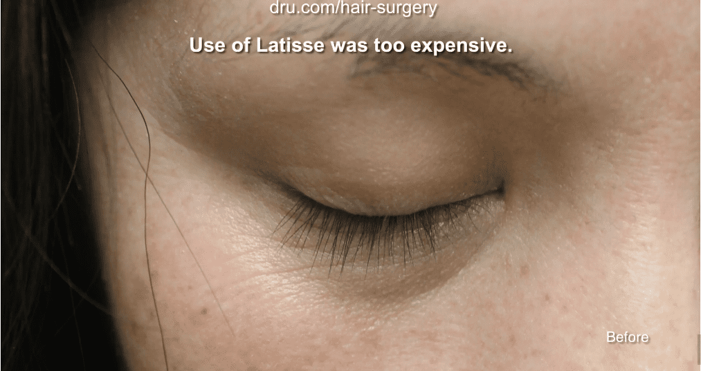The patient was having difficulty thickening her eyelashes before undergoing Dr.UGraft's eyelash implant surgery. The patient was having difficulty thickening her eyelashes before undergoing Dr.UGraft's eyelash implant surgery.