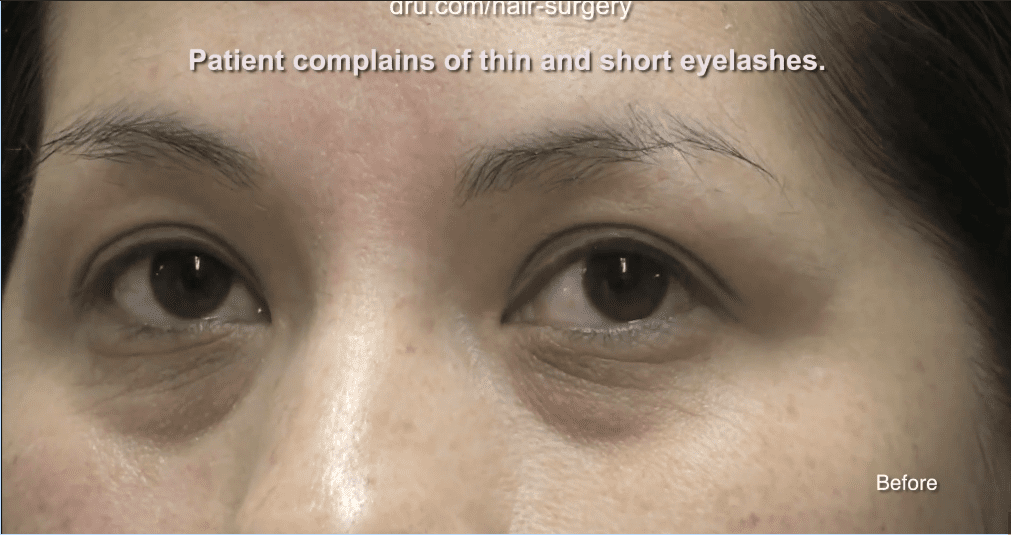 This patient had thin and sparse eyelashes before Dr.UGraft’s eyelash extension surgery This patient had thin and sparse eyelashes before Dr.UGraft’s eyelash extension surgery