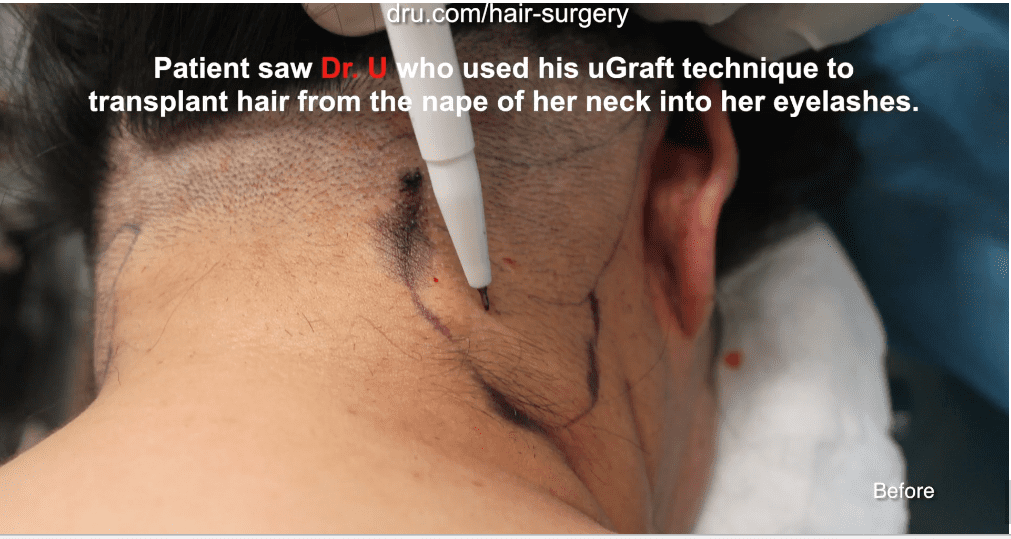 Dr.UGraft Eyelash Extensions surgery is how to get thicker eyelashes Dr.UGraft Eyelash Extensions surgery is how to get thicker eyelashes