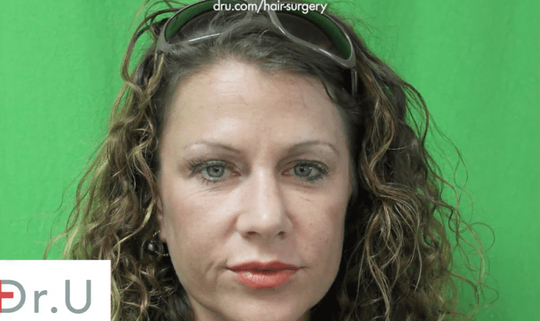 Eyebrow hair restoration Surgery: Before photos The patient hopes to correct the look of her thin, over-plucked eyebrows.