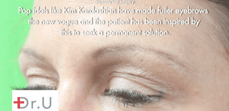 The patient before her eyebrow hair restoration surgery. Manhattan Beach patient before her eyebrow hair restoration surgery