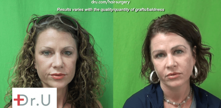 The patient before and after her eyebrow transplant which achieved the thick shaped eyebrows that she hoped for Manhattan Beach patient before and after her eyebrow transplant which achieved the thick shaped eyebrows that she hoped for