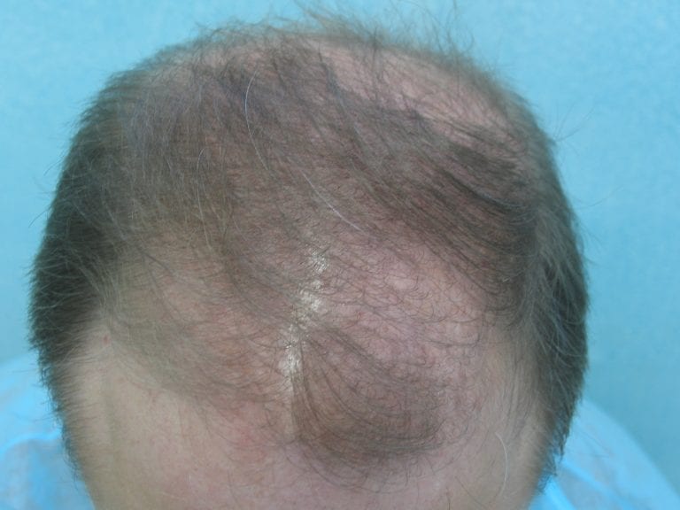 Top view of Norwood 6 FUE hair transplant patient's head Top view of Norwood 6 FUE hair transplant patient's head