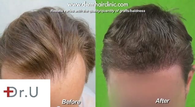 Before and After A 3000 Graft FUE Procedure Before and After A 3000 Graft FUE Procedure