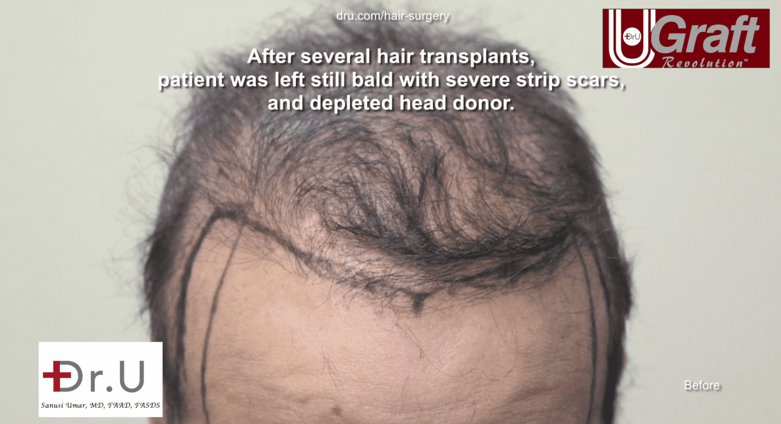 This patients hairline was completely undefined before his hair transplant with Dr. U. This patients hairline was completely undefined before his hair transplant with Dr. U.
