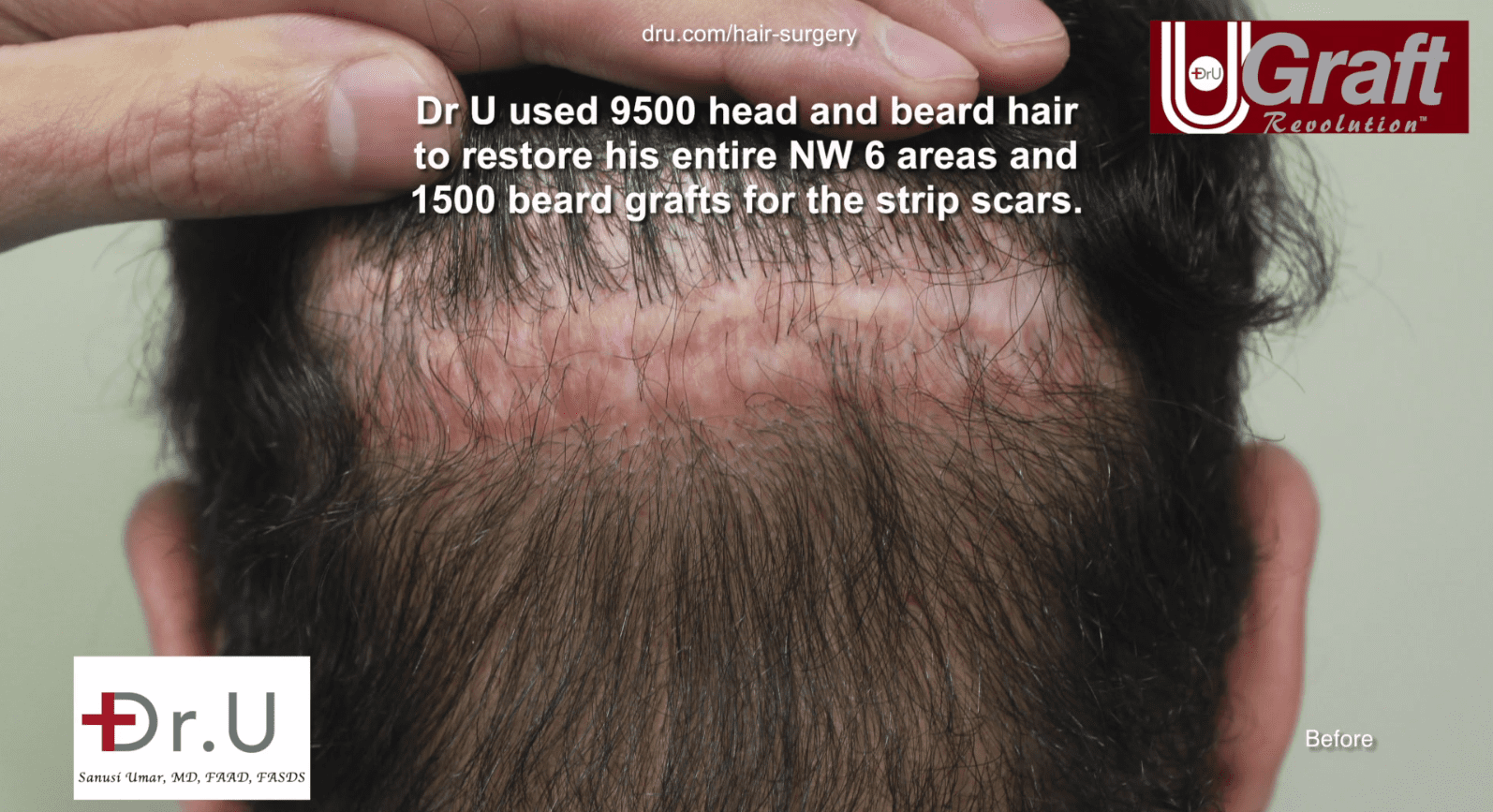 Photo of patient’s two scars before Dr. Umar’s beard to head hair transplant surgery Photo of patient’s two scars before Dr. Umar’s beard to head hair transplant surgery