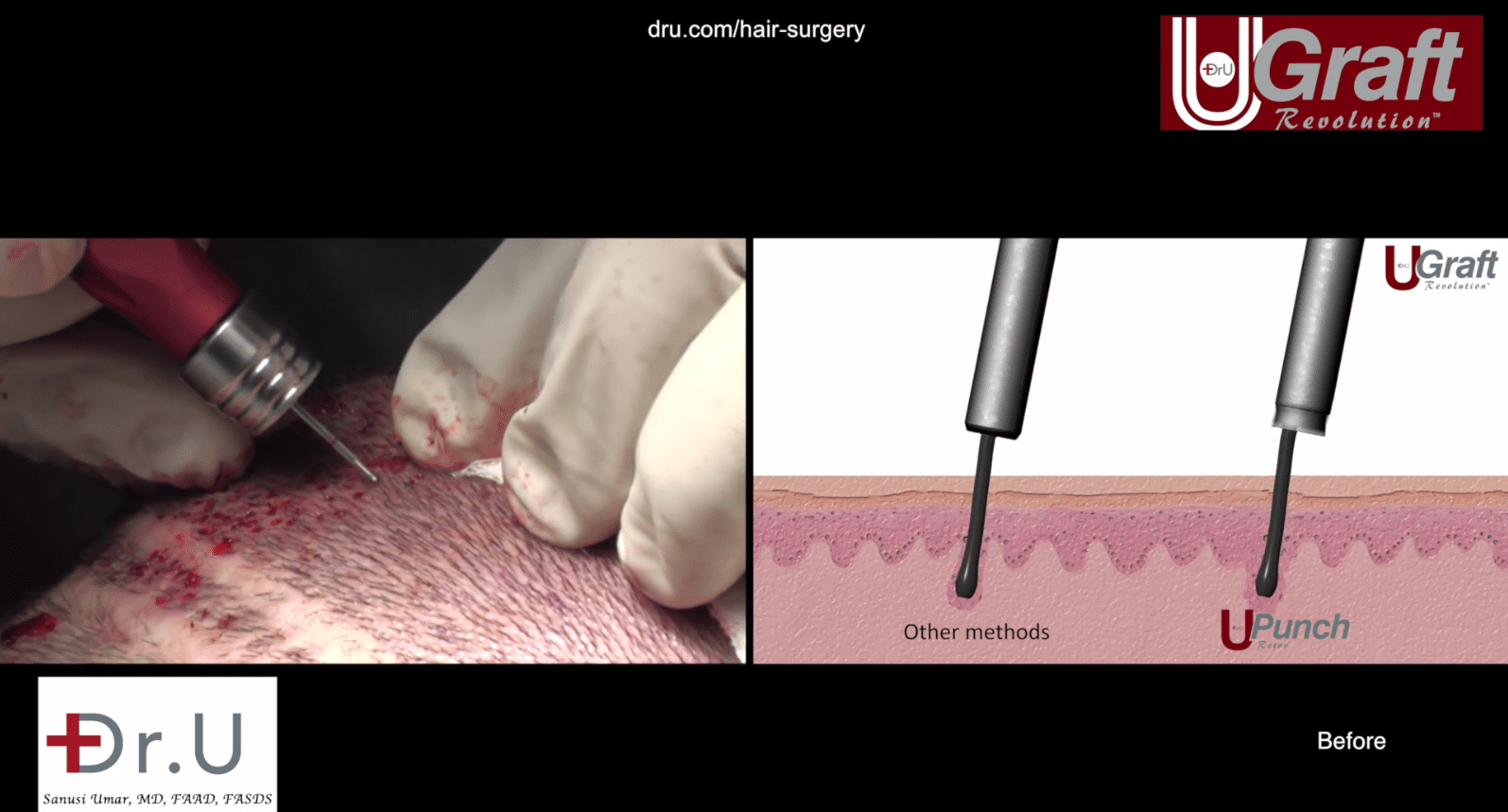 Dr. Umar is extracting hair follicles for this patient using his patented Dr.UGraft FUE technology. An irrigation system is utilized for a cleaner and easier process and to minimize scarring. Dr. Umar is extracting hair follicles for this patient using his patented Dr.UGraft FUE technology. An irrigation system is utilized for a cleaner and easier process and to minimize scarring.