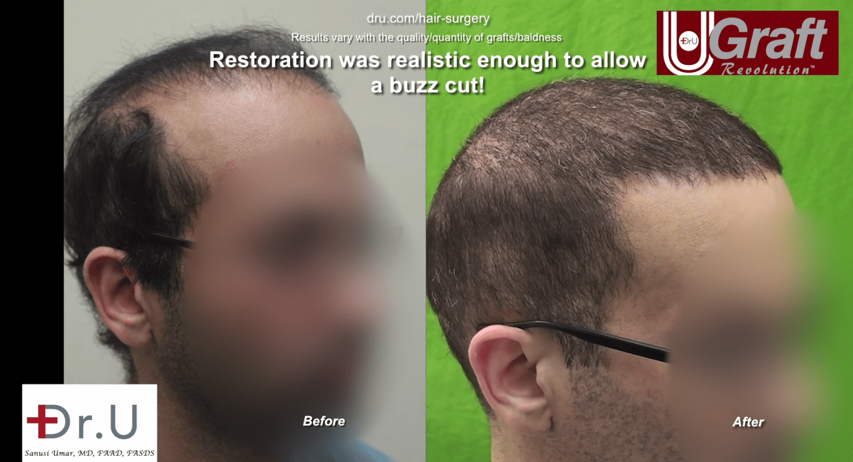 After his hair transplant surgery by Dr. U in Los Angeles, this patient now has filled in temples and a more prominent hairline After his hair transplant surgery by Dr. U in Los Angeles, this patient now has filled in temples and a more prominent hairline