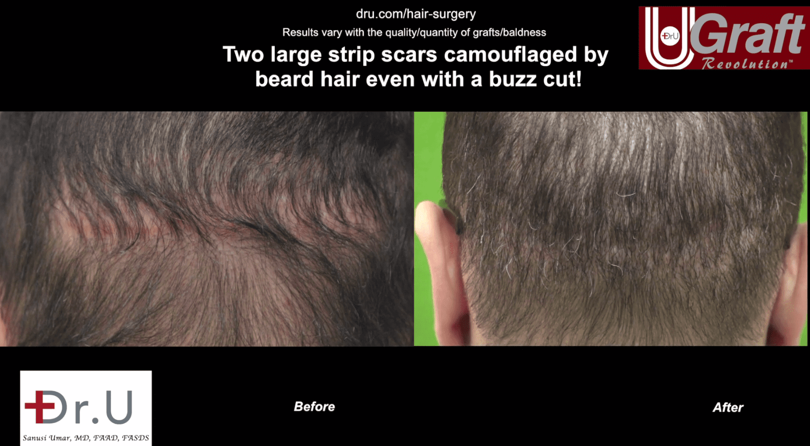 Previous scarring from a strip surgery is now visually insignificant thanks to the Dr.UGraft procedure, allowing the patient to sport a short haircut after hair transplant scar removal. Previous scarring from a strip surgery is now visually insignificant thanks to the Dr.UGraft procedure, allowing the patient to sport a short haircut after hair transplant scar removal.