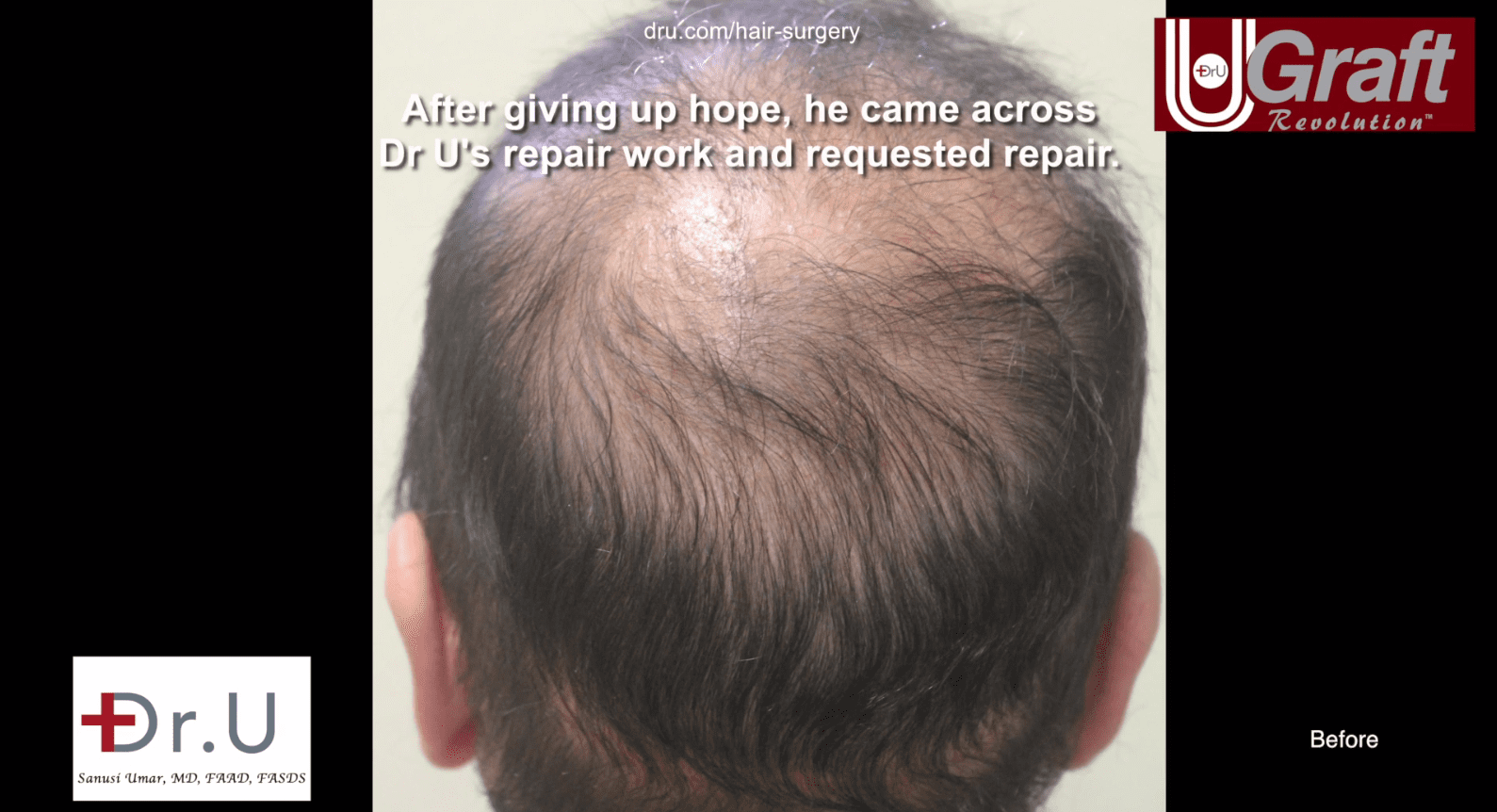 This patient was no longer ale to cover his balding regardless of an attempted comb-over. This patient was no longer ale to cover his balding regardless of an attempted comb-over.