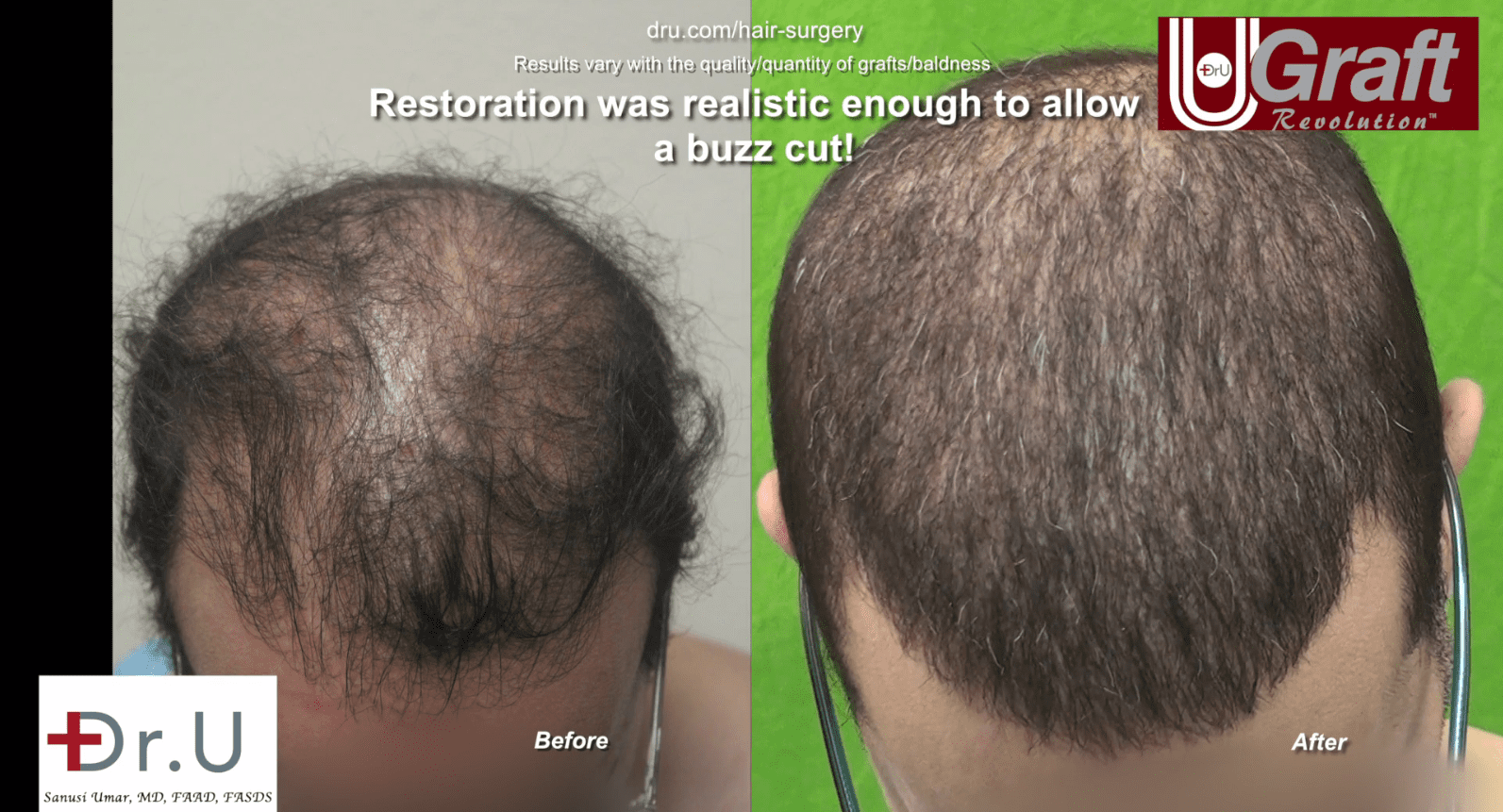 Dr. Umar's hair transplant using beard hair restores NW6 hair loss successfully Dr. Umar's hair transplant using beard hair restores NW6 hair loss successfully