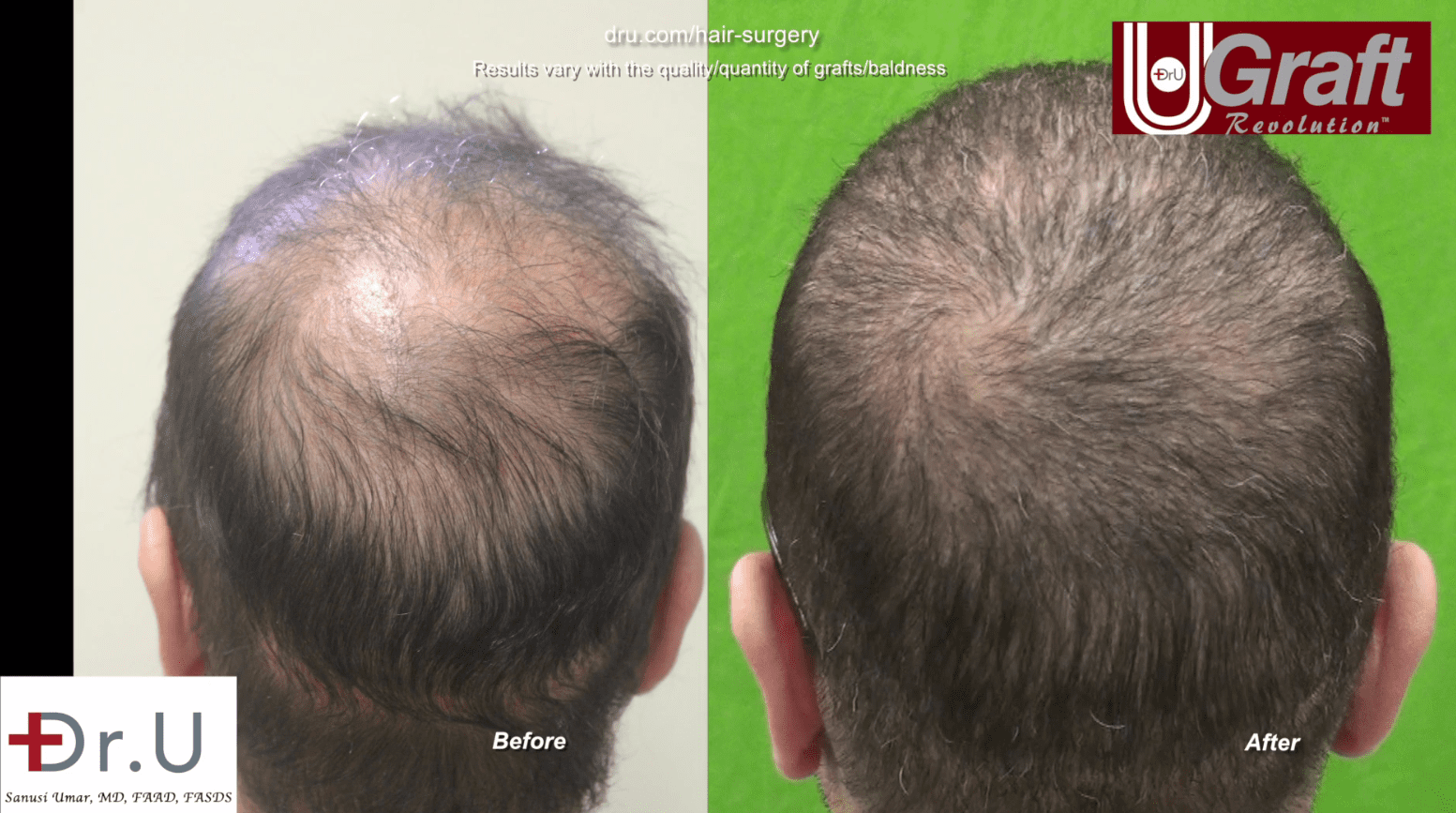 This patient no longer needs to worry about strategically brushing his hair in an attempt to cover his balding. This patient no longer needs to worry about strategically brushing his hair in an attempt to cover his balding.