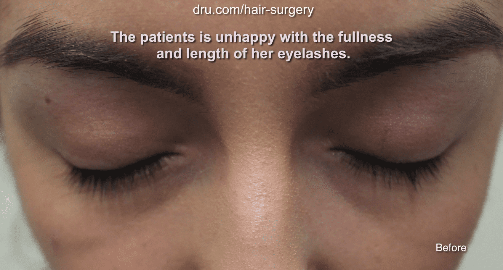 The patient was unsatisfied with the lack of density and length of her eyelashes before her eyelash hair transplantation with Dr. U. The patient was unsatisfied with the lack of density and length of her eyelashes before her eyelash hair transplantation with Dr. U.