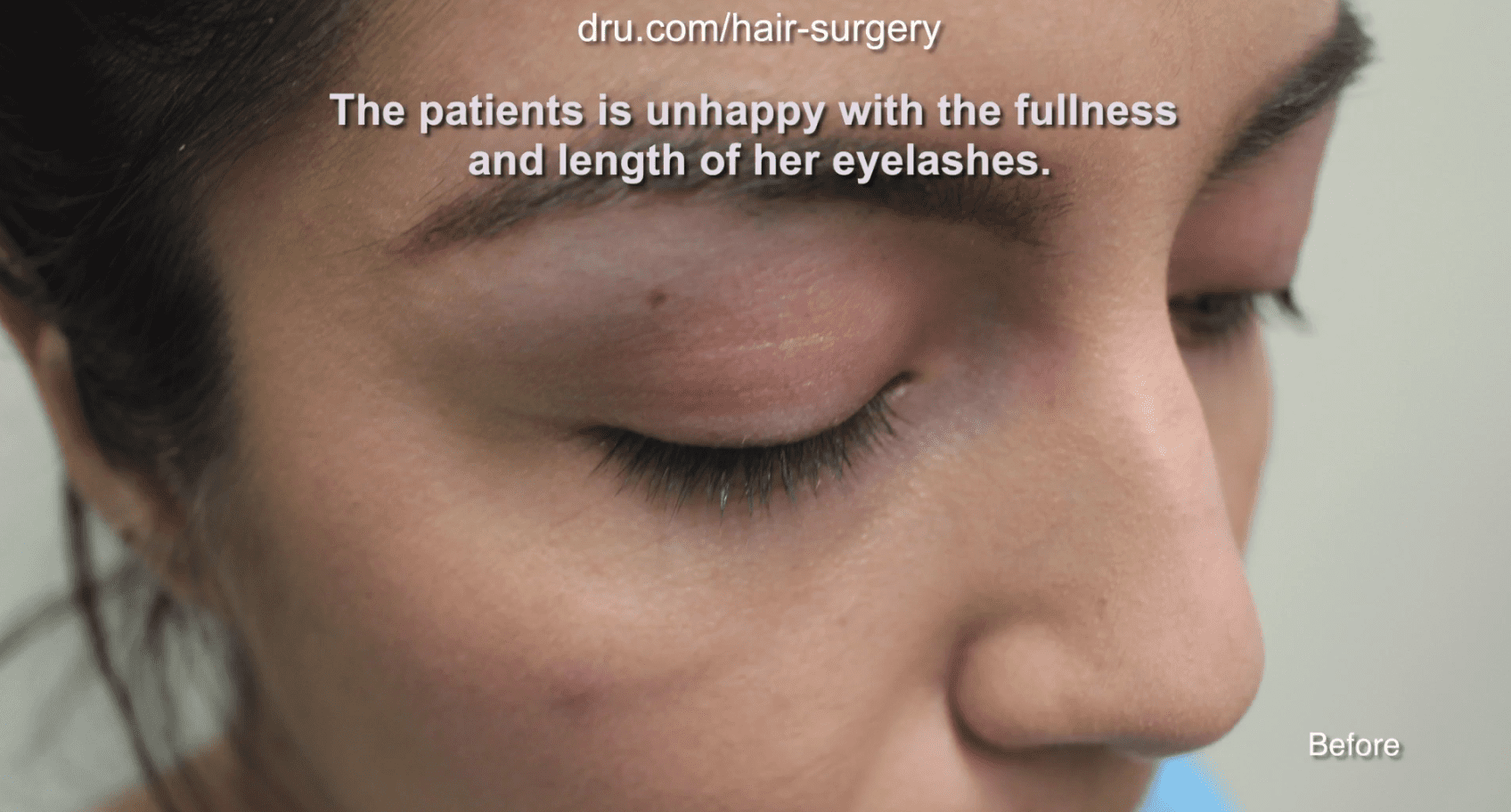 Instead of continuing to style her eyelashes everyday to her desired density and length, the patient decided to consult Dr. U about an eyelash hair transplant. Instead of continuing to style her eyelashes every day to her desired density and length, the patient decided to consult Dr. U about an eyelash hair transplant.