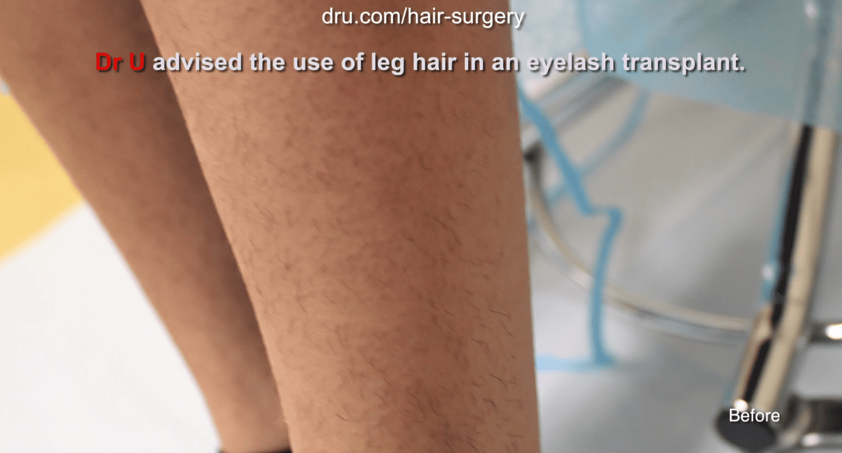 Dr. U used the patient's leg as the donor area for the eyelash surgery. While most hair clinics would struggle with the angled growth of body hair during the extraction process, Dr. U had the Dr. UGraft advantage and was able to safely and effectively harvest the grafts needed. Dr. U used the patient's leg as the donor area for the eyelash surgery. While most hair clinics would struggle with the angled growth of body hair during the extraction process, Dr. U had the Dr. UGraft advantage and was able to safely and effectively harvest the grafts needed.