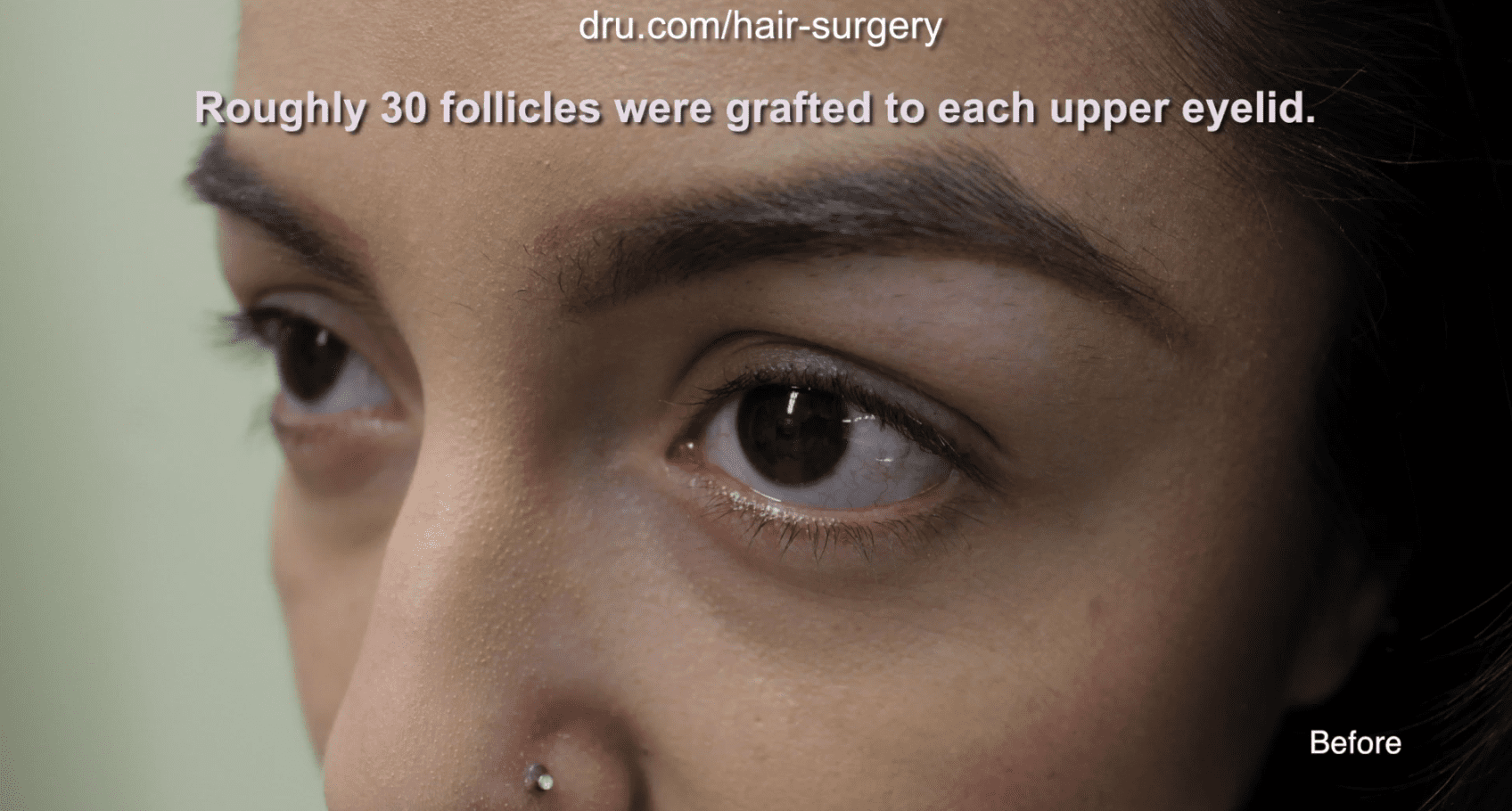 The Dr.UGraft allows for the use of any body hair, which gives the transplanted eyelashes their natural appeal. The Dr.UGraft allows for the use of any body hair, which gives the transplanted eyelashes their natural appeal.