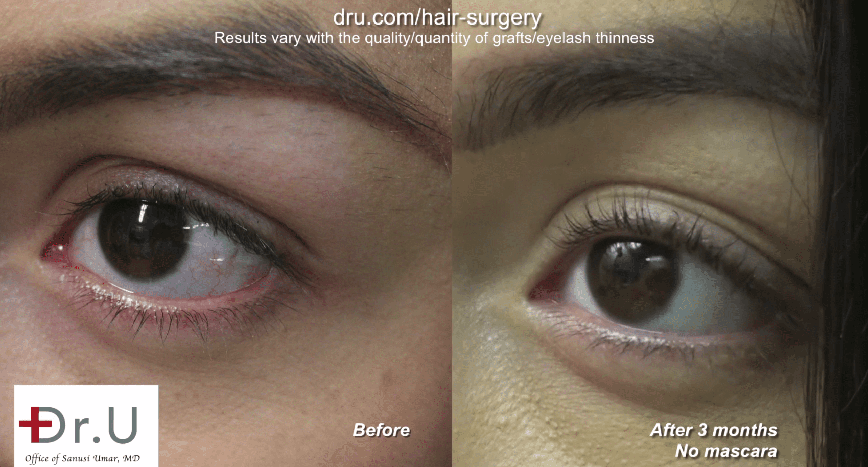 3 months post-operation, the patient noticed fuller and longer eyelashes. 3 months post-operation, the patient noticed fuller and longer eyelashes.