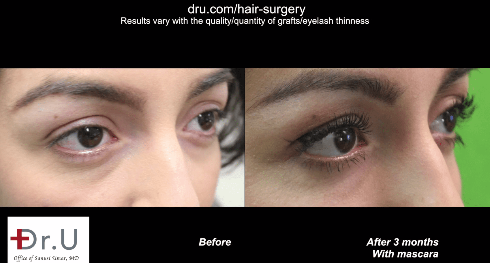Dr.U was able to create natural looking curvature and angles for the transplanted lashes. This eyelash surgery before and after photo is from 3 months after the transplant.* Dr.U was able to create natural looking curvature and angles for the transplanted lashes. This eyelash surgery before and after photo is from 3 months after the transplant.*