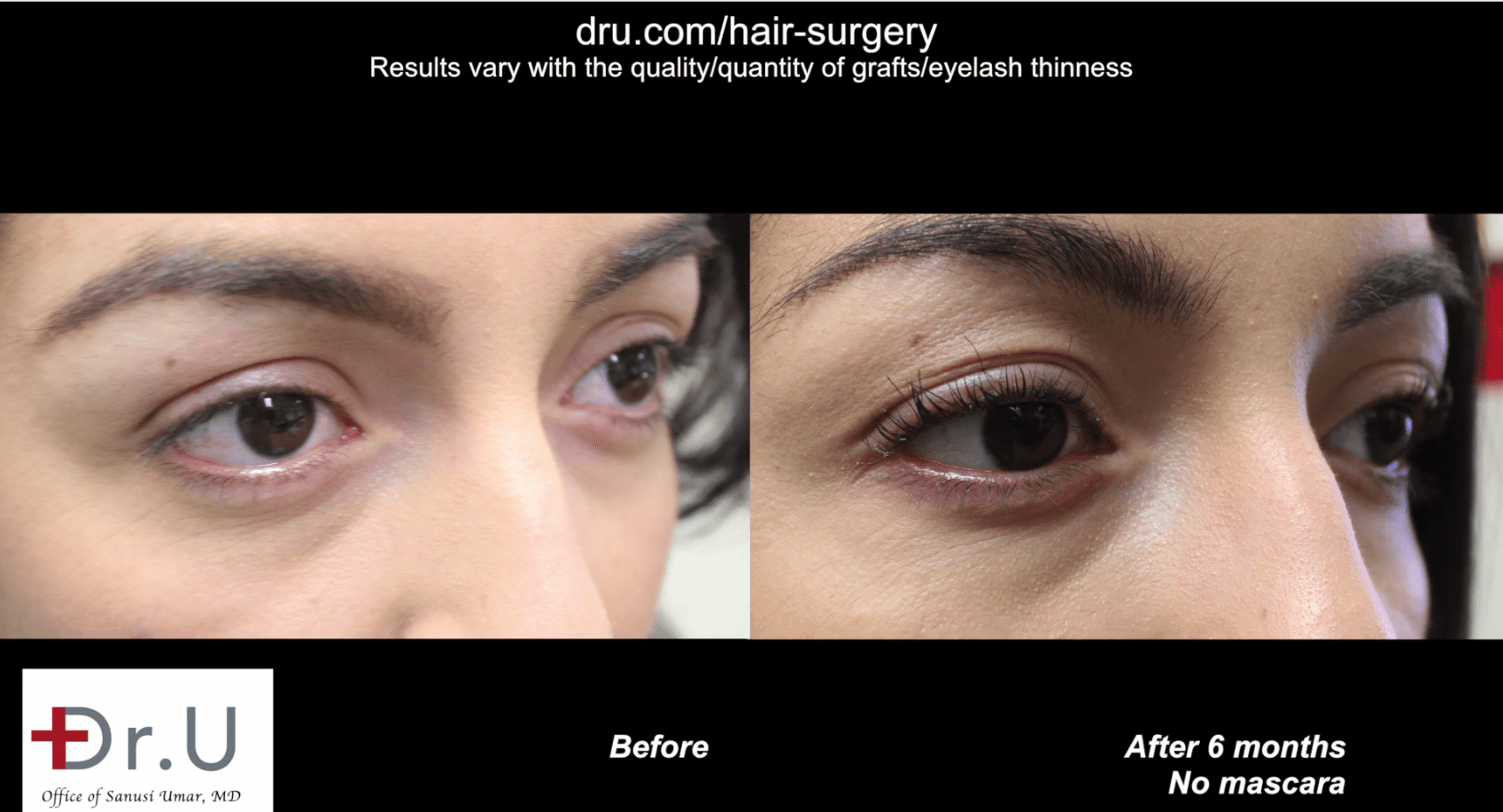 6 months after her surgery, the patient enjoys the fact that her permanent eyelashes require much less perming 6 months after her surgery, the patient enjoys the fact that her permanent eyelashes require much less perming