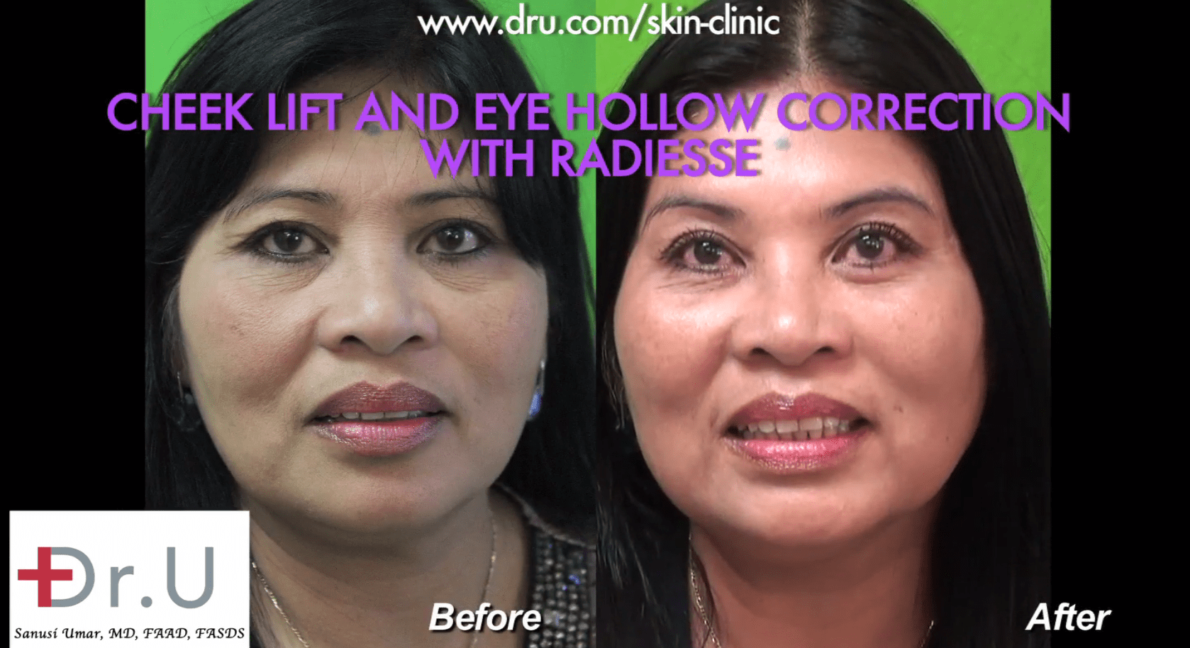 Before and after the patient's non surgical cheek lift and hollow eye treatment.* Before and after the patient's non surgical cheek lift and hollow eye treatment.*