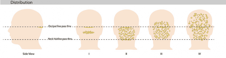 The stages of AKN, which can look like lumps on head under hair, are depicted above. The stages of AKN, which can look like lumps on head under hair, are depicted above.