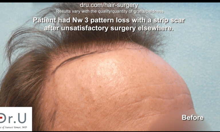 Norwood 3 patient before Dr. U hairline and strip scar repair. Norwood 3 patient before Dr. U hairline and strip scar repair.