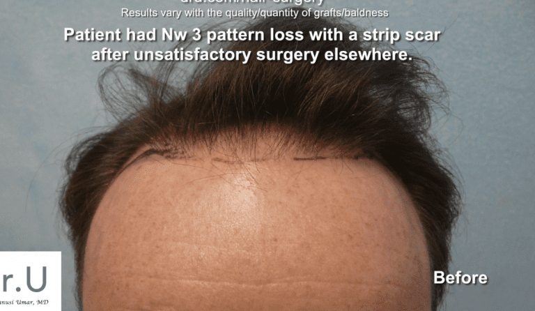 Strip scar from FUSS surgery performed at a different clinic This Studio City patient wants to get rid of a hair transplant scar from a FUSS surgery performed at a different clinic.