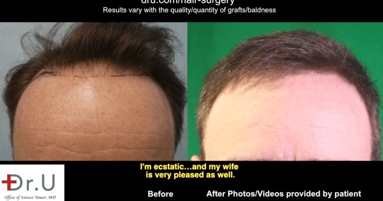 In order to restore and refine the hairline in his Studio City patient, Dr. Umar harvested donor hair from both the head and body. In order to restore and refine the hairline in his Studio City patient, Dr. Umar harvested donor hair from both the head and body.