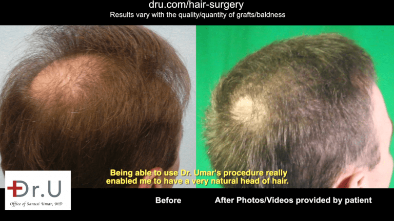 Dr. U was able to get rid of hair transplant repair scar. Using UGraft technology, Dr. Umar was able to get rid of a hair transplant scar by providing more coverage where the patient desired