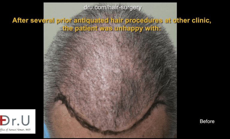 Before Corrective hair surgery with Dr. U Due to the common misconception that older procedures are more reliable, individuals such as the patient above are faced with the problem of repairing older hair restorations results.