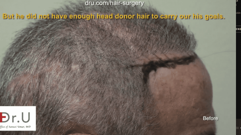 Results from plugs and other outdated procedures with other doctors. The patient was unhappy with the results from other outdated procedures, like hair plugs, but his depleted head hair donor supply prevented him from seeking other options.