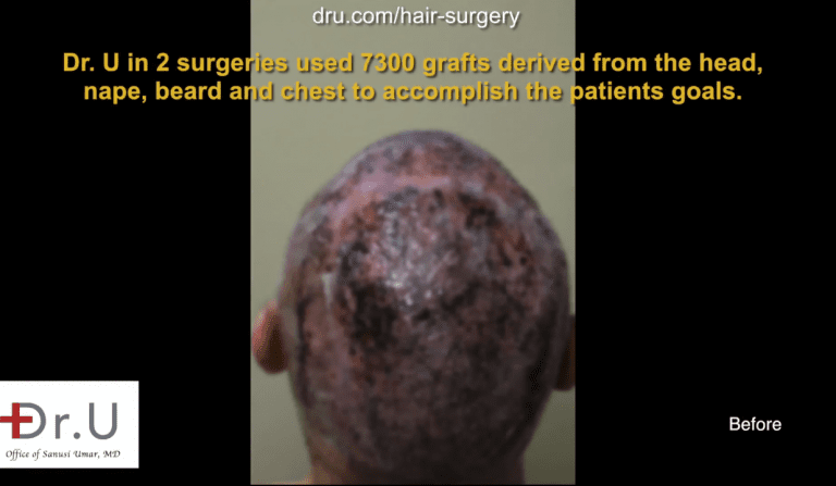 Dr.UPunch Rotor used for hair surgery correction. While other clinics might have turned this Newport Beach man away due to insufficient donor hair on the head, Dr. U used an advanced BHT FUE system to provide more grafts to reduce the appearance of hair plugs and scars from other surgeries.