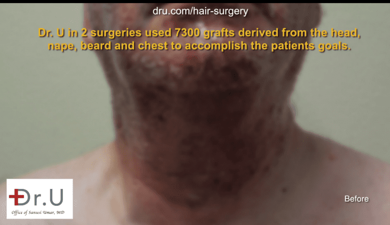 Dr. U harvested hair from the head, nape, beard and chest to expand the donor pool until sufficient grafts were available for a hair surgery correction. Dr. U harvested hair from the head, nape, beard and chest to expand the donor pool until sufficient grafts were available for a hair surgery correction.