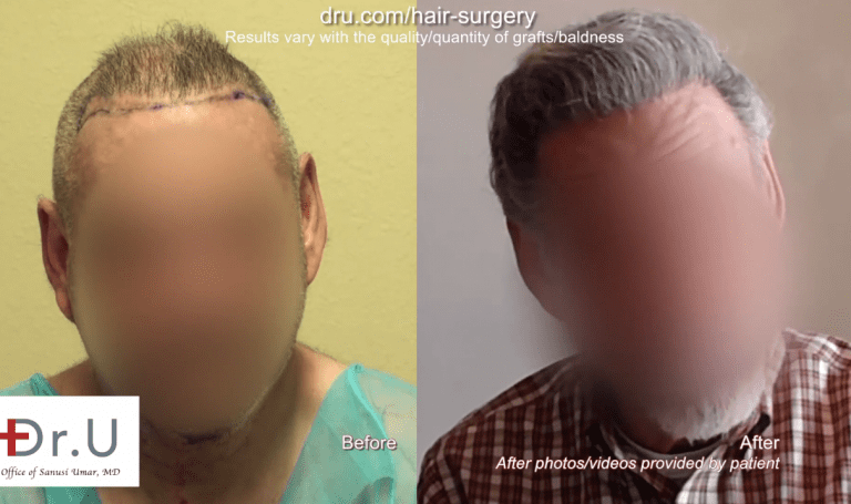 Best corrective hair surgery results Instead of living unhappily with the results of outdated hair restoration procedures, this patient researched the best corrective hair surgery available and achieved the coverage he wanted.