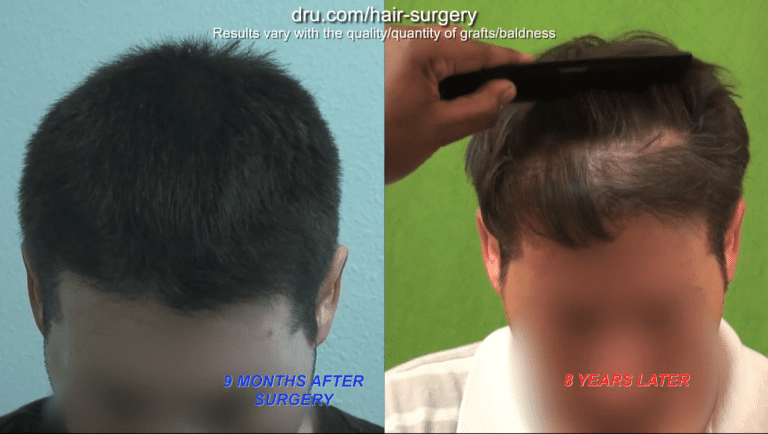 When you seek a hair transplant in your 20s, the natural progression of hair loss can be expected to manifest When you seek a hair transplant in your 20s, the natural progression of hair loss can be expected to manifest