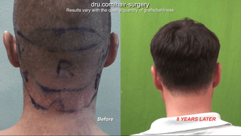 Touch up after a hair transplant in your 20s. Getting a hair transplant in your 20s will most likely require future surgery in later years