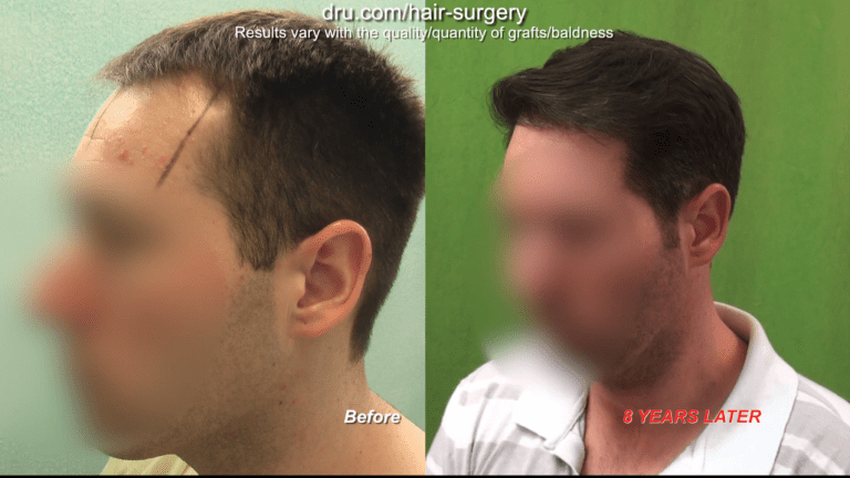 Results from a FUE hairline revision with Dr. U.* Planning your hair restoration at a young age requires anticipating future surgeries