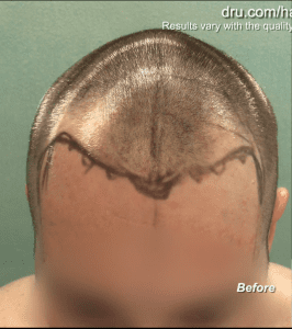 Patient shown right before his first FUE hairline revision eight years prior Patient shown right before his first FUE hairline revision eight years prior