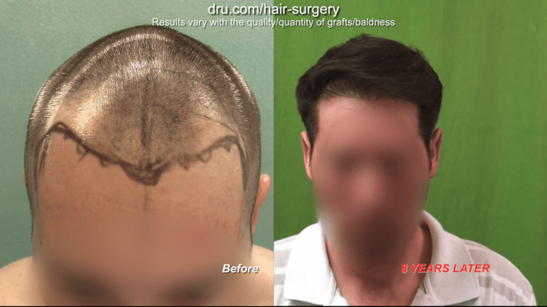 Stronger and fuller head of hair following a FUE hairline revision.* There is not necessarily a best age for a hair transplant if a patient and doctor can work through commonly understood goals and expectations