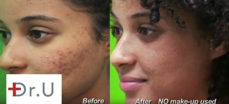 A laser acne scar treatment creates new collagen to improve the skin's texture A laser acne scar treatment creates new collagen to improve the skin's texture