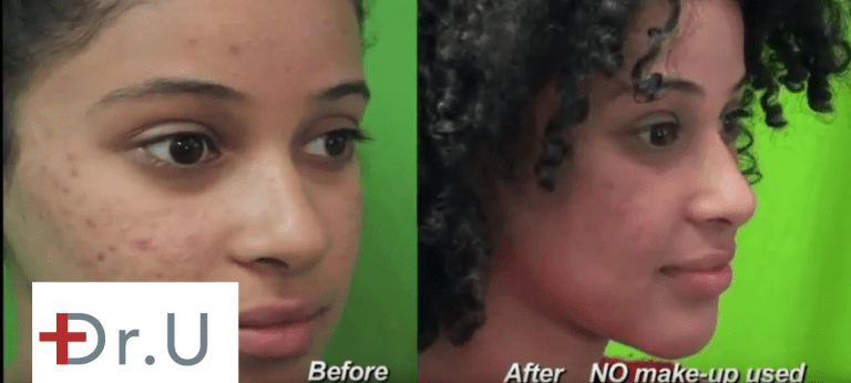 Patient opted for treating acne scars with Fraxel Dual - before and after photos Patient opted for treating acne scars with Fraxel Dual - before and after photos