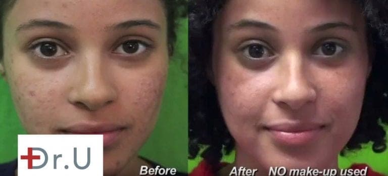 Ethnic patients can safely get rid of acne scars with Fraxel Dual Ethnic patients can safely get rid of acne scars with Fraxel Dual