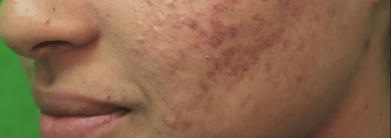 Patient who wants to improve acne scars on her face Patient who wants to improve acne scars on her face