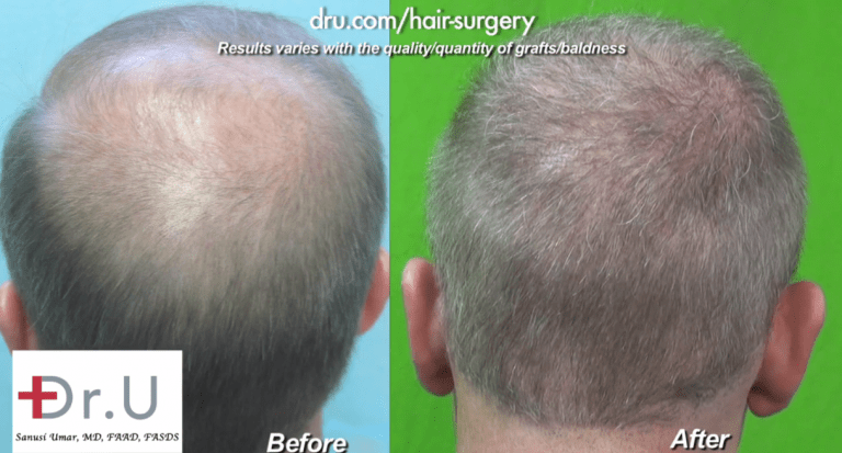 View of Crown for Norwood 6 before and after Dr.UGraft Surgery View of Crown for Norwood 6 before and after Dr.UGraft Surgery