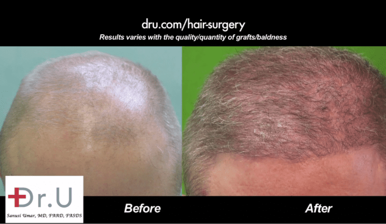 Hairline restoration for Norwood 6 Before and After Dr.UGraft Hairline restoration for Norwood 6 Before and After Dr.UGraft