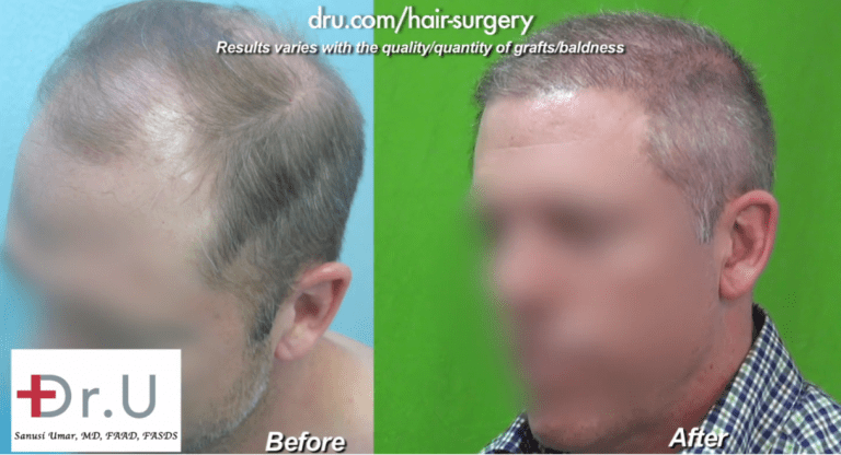 Three Quarters View of NW 6 Hair Transplant Using Dr.UGraft Three Quarters View of NW 6 Hair Transplant Using Dr.UGraft